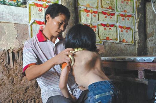 有嚴(yán)重脊椎畸形及胸腔隆突病的李文霞。