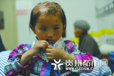 被燙傷的頭皮一直沒有愈合。