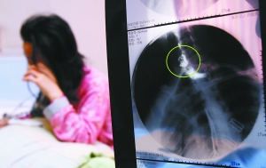 假牙上的鋼絲刺破食管，而薄薄的食道壁緊貼主動脈血管，極易造成血管破裂