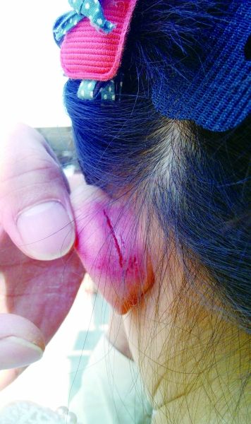 　　女童的耳朵被老師揪裂。圖片由女童家人提供