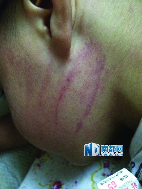 小逸臉上淤痕清晰可見。