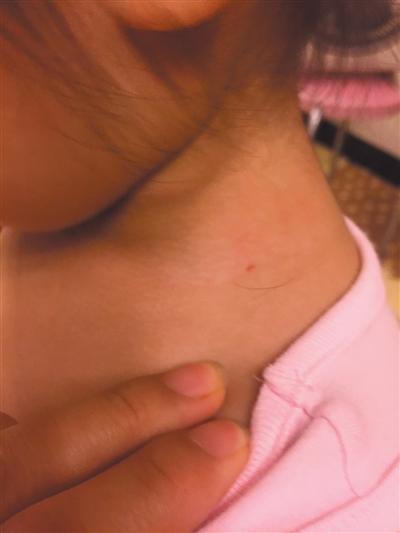 北京兩幼兒身現(xiàn)傷口稱遭老師針扎 幼兒園否認(rèn)