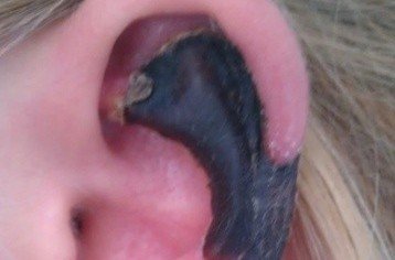 荷蘭女子旅游途中被蜘蛛咬，耳軟骨溶解變黑。