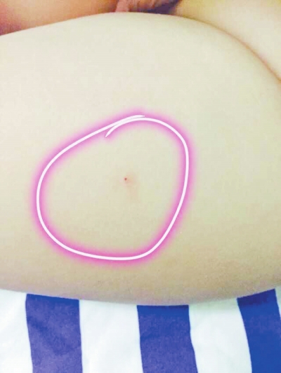 幼兒身上的“針點(diǎn)狀銳器傷”傷痕