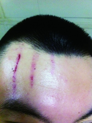 　2013年，被打者受傷照