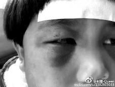 6月2日，網(wǎng)曝渭南市臨渭區(qū)一不滿5歲的女童遭奶奶毆打，眼圈青腫，引起網(wǎng)友關(guān)注，但孩子父母和爺爺均稱是摔倒導致。相關(guān)部門介入調(diào)查發(fā)現(xiàn)確為奶奶毆打所致，鑒于其身體原因已進行批評教育。