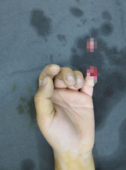 嚇哭！6歲男孩被夾斷手指 罪魁禍首竟是校服