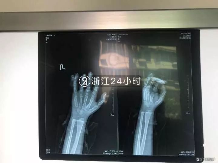 嚇哭！6歲男孩被夾斷手指 罪魁禍首竟是校服