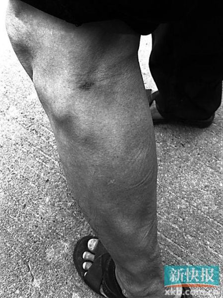 傷者身上遺留的彈痕。