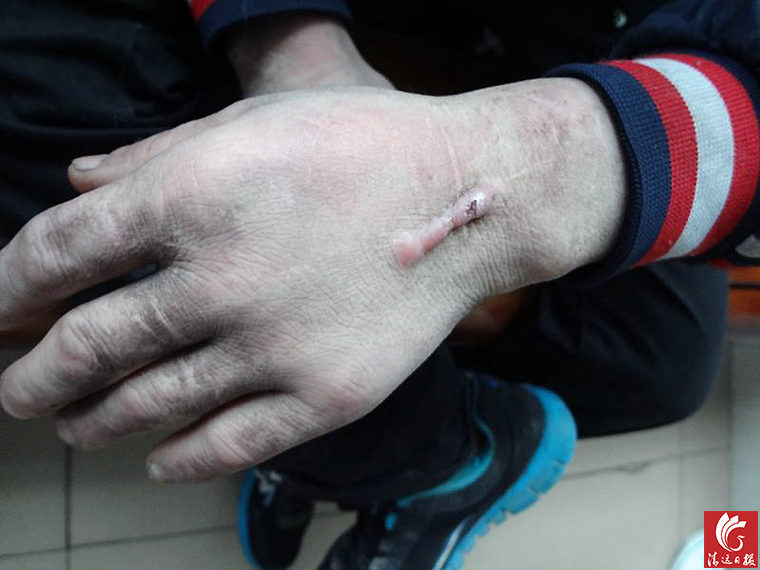 被發(fā)現(xiàn)男子手上的傷疤。