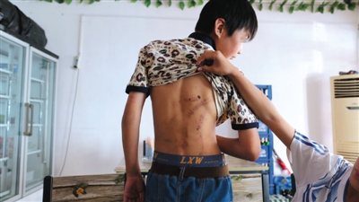 　昨日，奶西村，被打的小剛后背上條條瘀痕依然明顯。