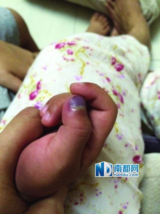 小逸手指被夾傷。