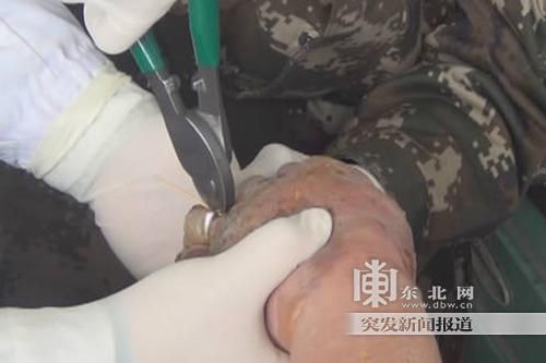 正在拆除戒指。