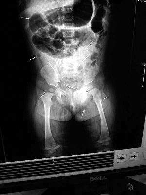 目前體內(nèi)的12根鋼針多分布在孩子的臀部，一根在腹部，其余3根在胸腔附近，其中一根很接近心臟