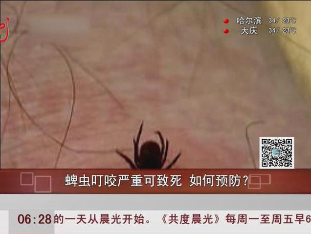 蜱蟲叮咬嚴(yán)重可致死如何預(yù)防？