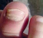 一幼兒園兒童“指甲異?！? title=